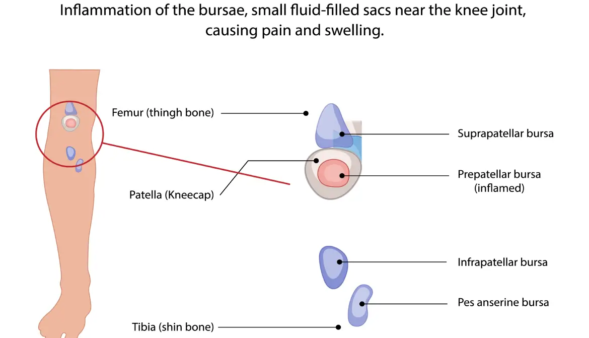 Laparoscopic Ovarian Cystectomy